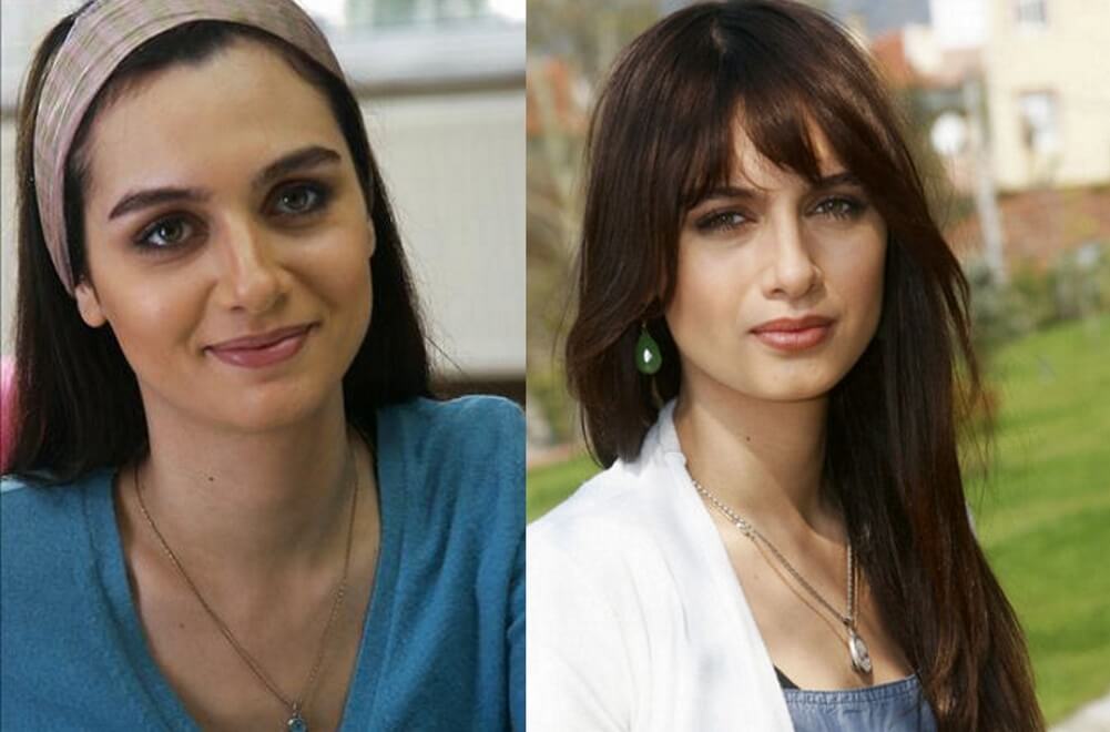 Бирдже и&nbsp;ринопластика