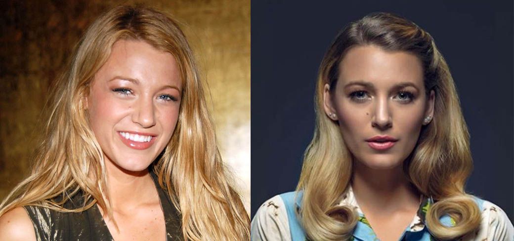 Блейк Лайвли блефаропластика