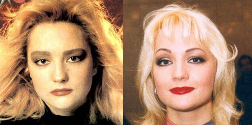 Буланова до и после пластики