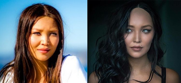 Дарина Эрвин ринопластика