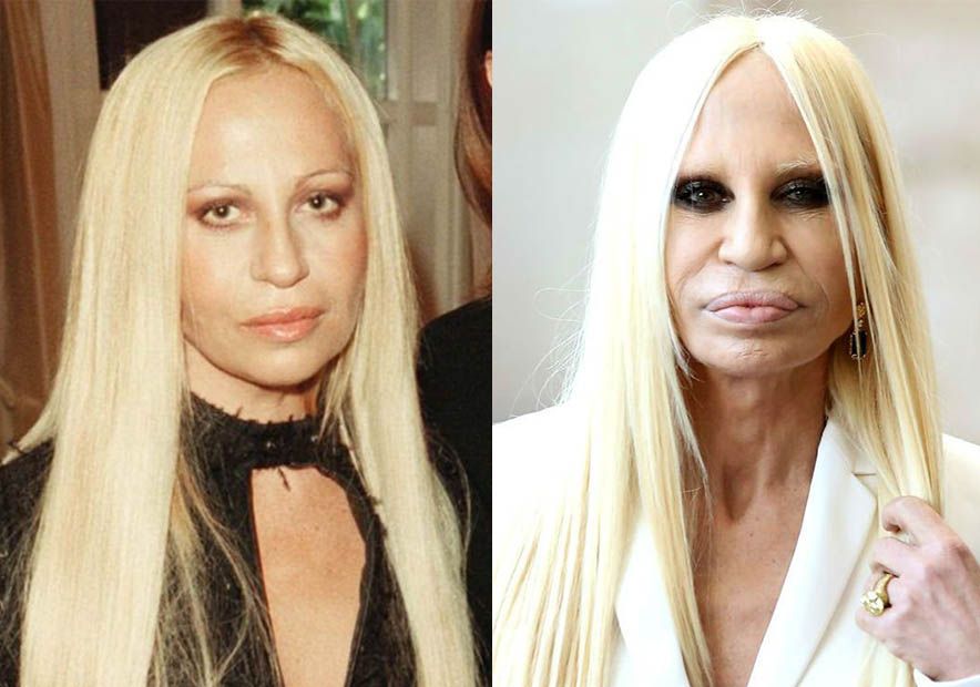 Донателла Версаче до и после пластики