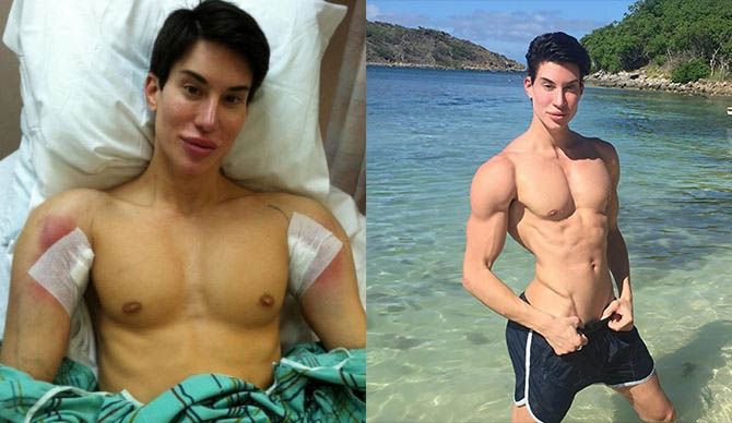 Джадлика пластика подмышек