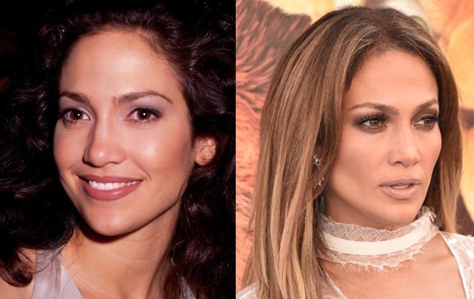 Дженнифер Лопес подтяжка лица