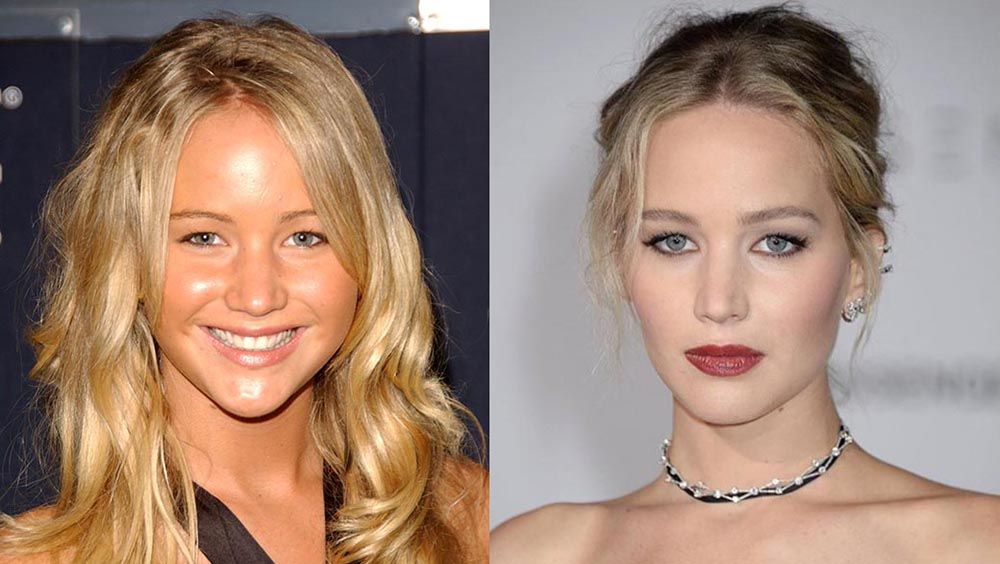 Дженнифер Лоуренс блефаропластика