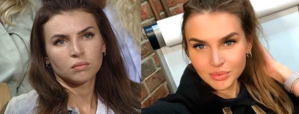 Элла Суханова ринопластика