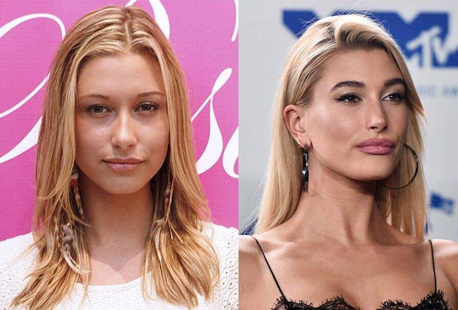 Хейли Болдуин блефаропластика