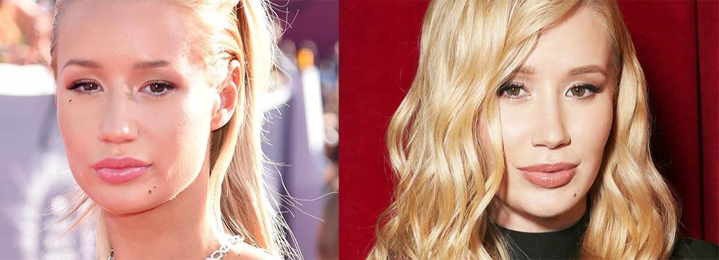 Игги Азалия пластика подбородка и скул, филлеры