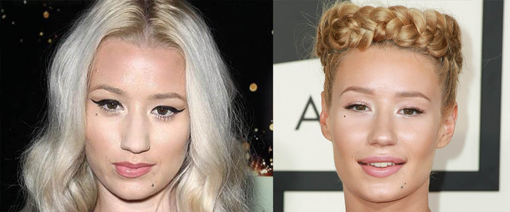 Игги Азалия Ринопластика