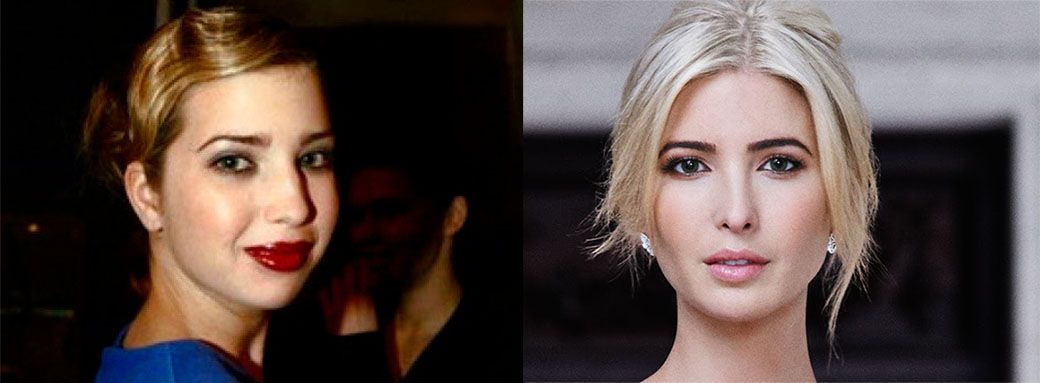 Иванка до&nbsp;и&nbsp;после уменьшения губ