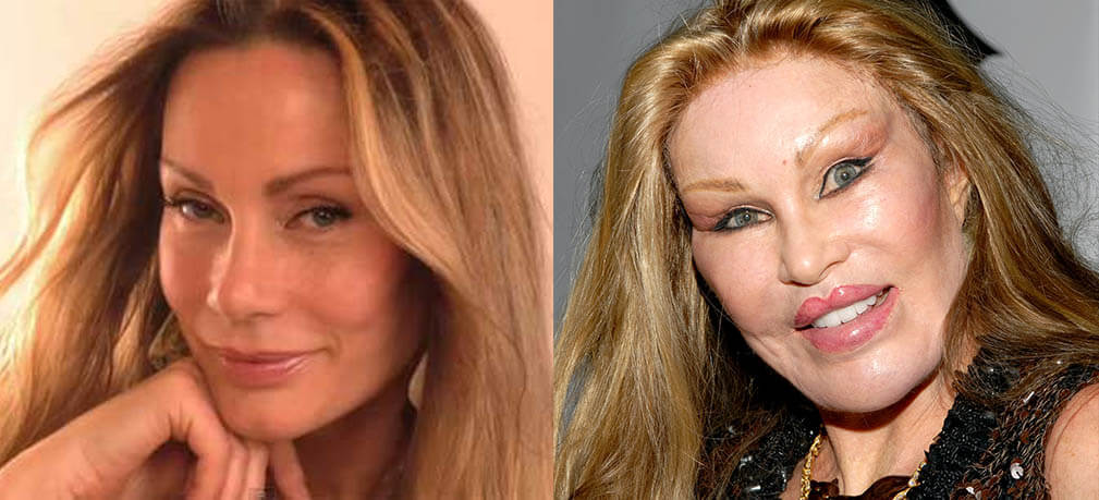 Джоселин Вильденштей до и после пластики