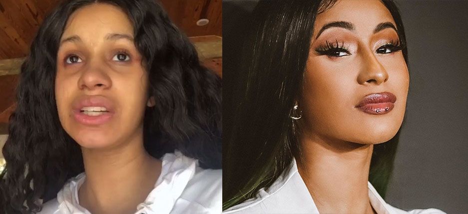 Карди Би ринопластика