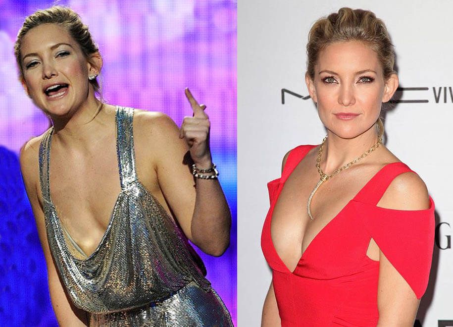 Кейт Хадсон и пластика груди