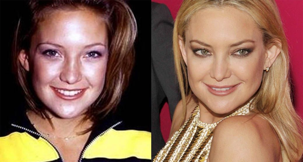 Кейт Хадсон и ринопластика