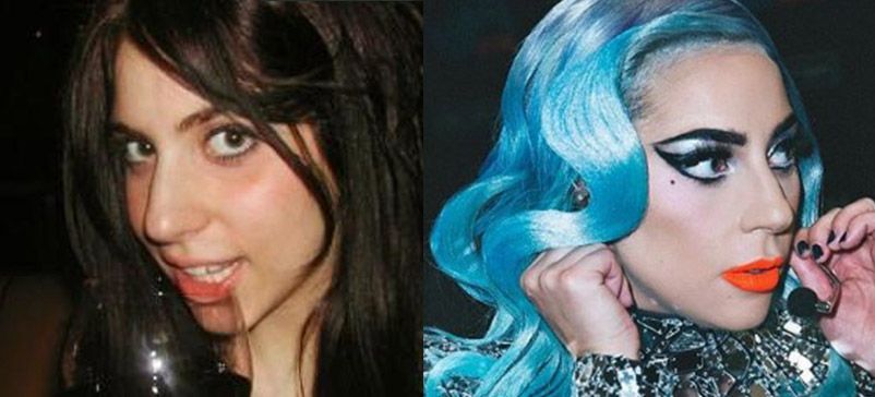 леди гага ринопластика