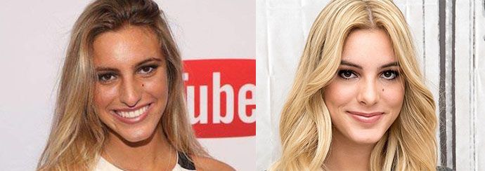 Леле Понс ринопластика