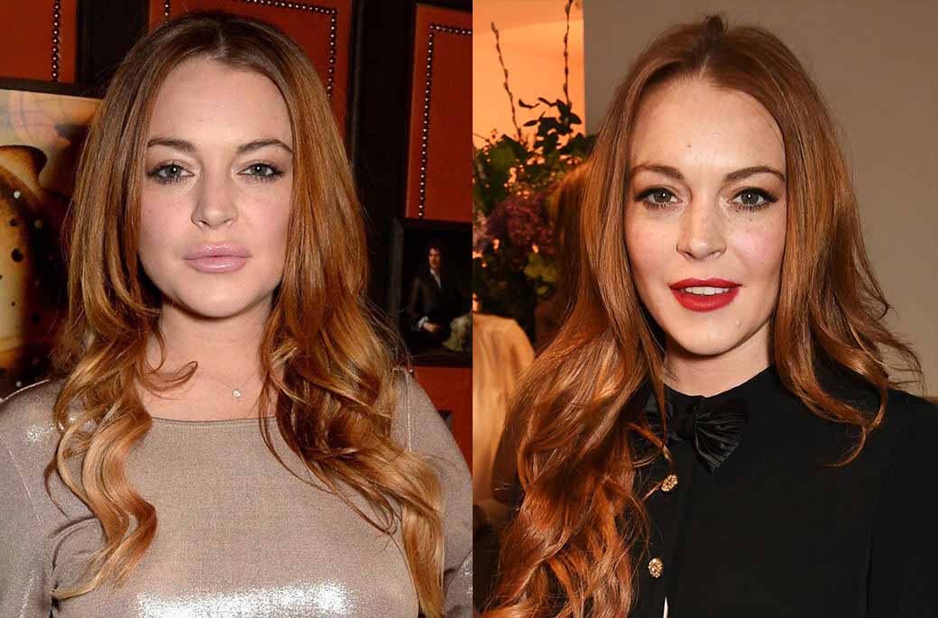 Линдси до&nbsp;и&nbsp;после уменьшения губ