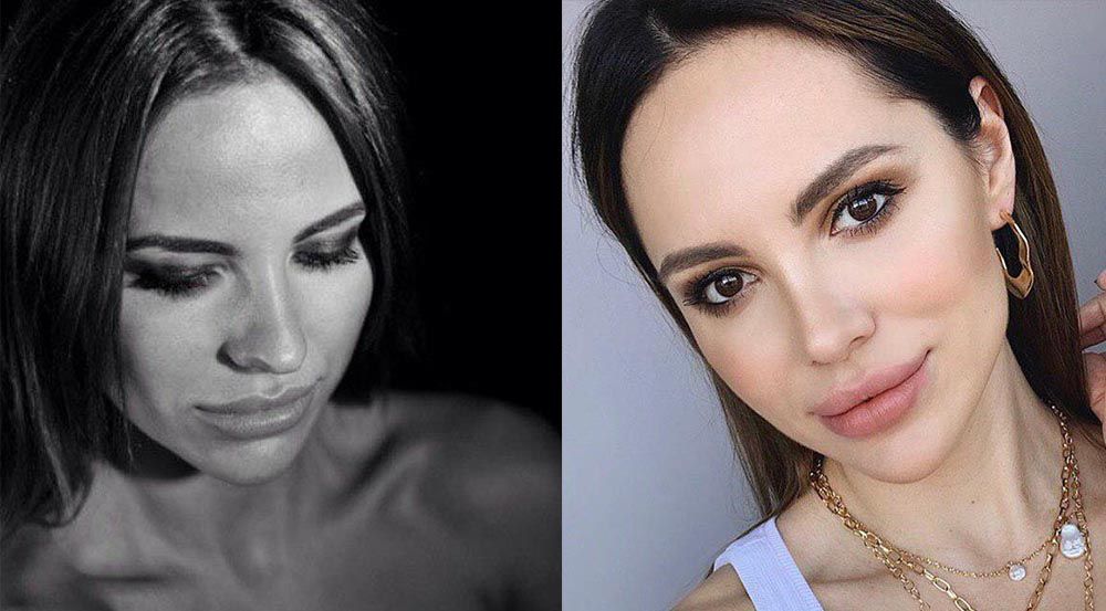 Лиза Шатилова ринопластика