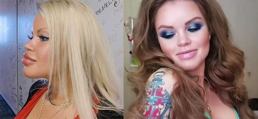 Малибу до&nbsp;и&nbsp;после уменьшения губ