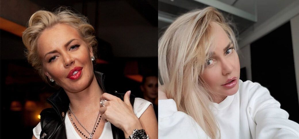 Малиновская до&nbsp;и&nbsp;после уменьшения губ