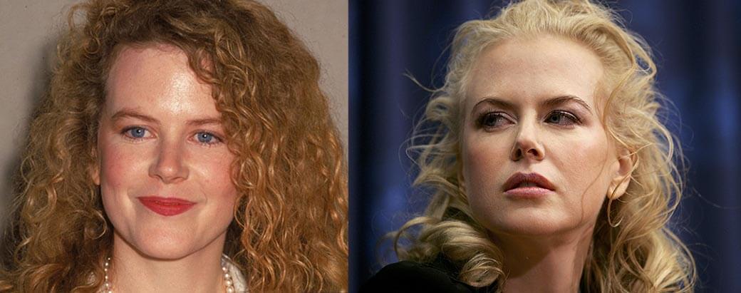 Николь Кидман ринопластика и хейлопластика