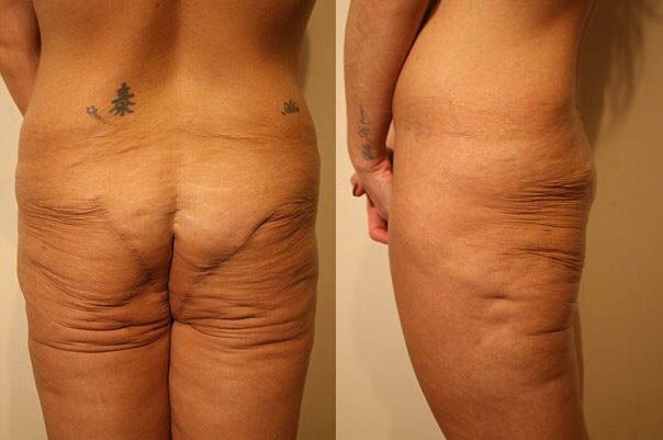 Отсутствие ягодиц