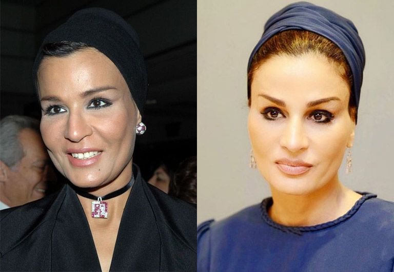 Шейха Моза блефаропластика