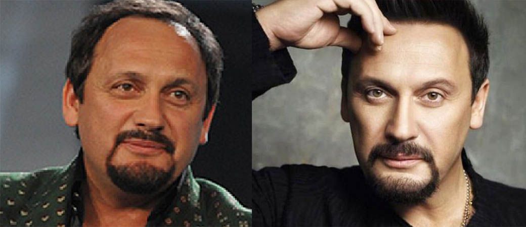 Стас Михайлов до и после пластики лица