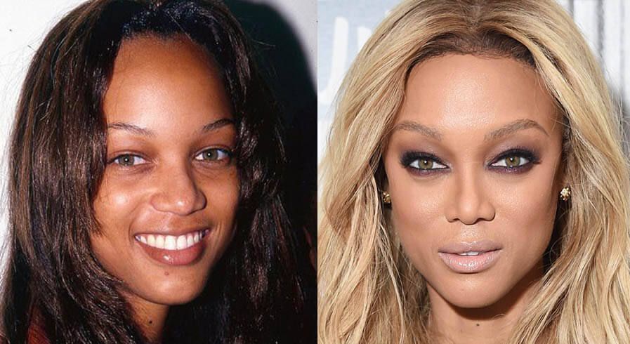 тайра и&nbsp;пластика носа