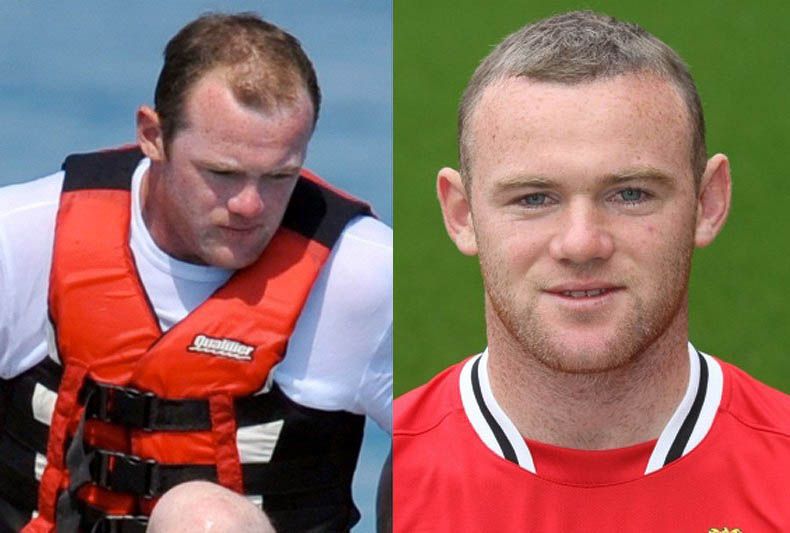 Уэйн Руни до и после пересадки волос