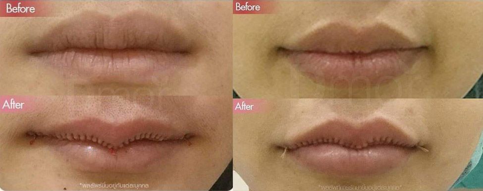 Ушивание губ до и после