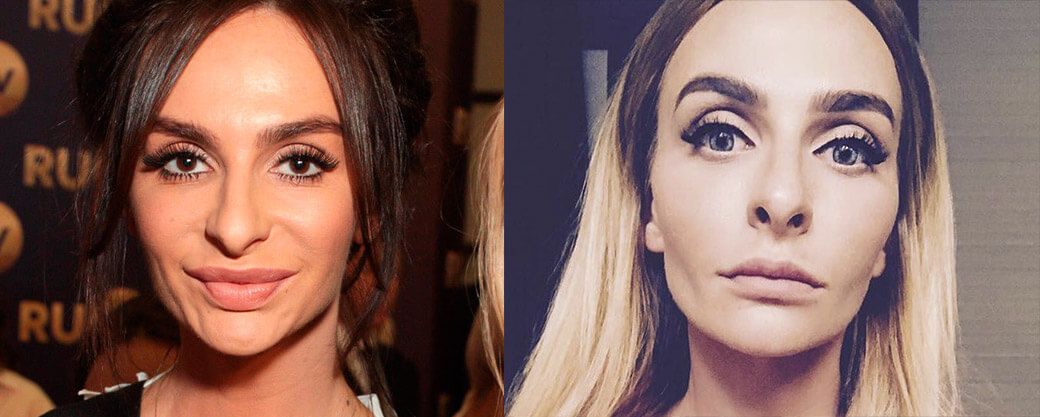 Варнава до&nbsp;и&nbsp;после уменьшения губ