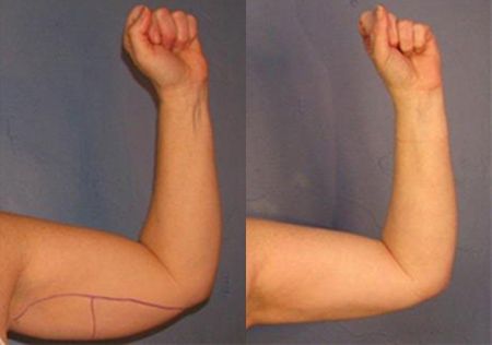 Эффект пластики рук у&nbsp;мужчин