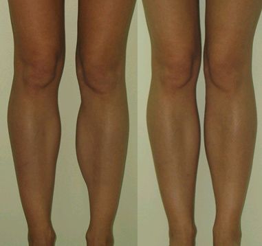 Результат комплексной коррекции голеней и лодыжек