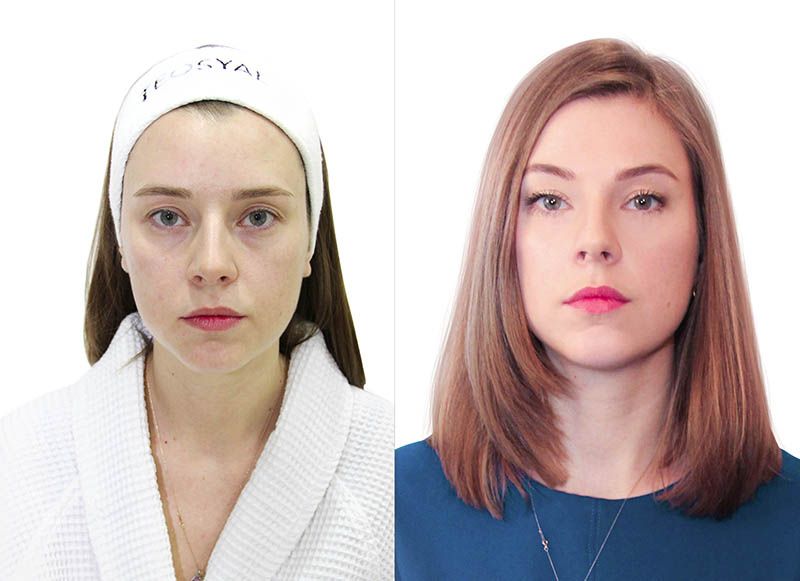 Пластика лица в 30 лет