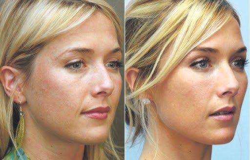 Эффект подтяжки в 35 лет