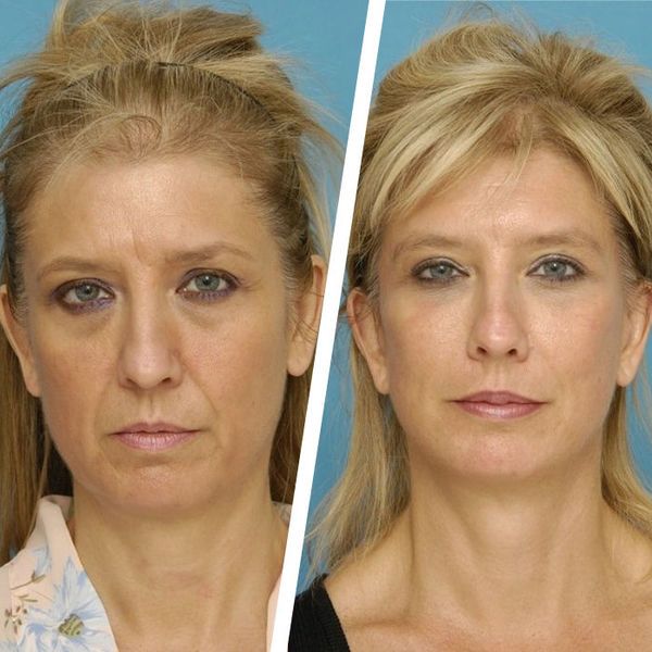 Пластика лица в 50 лет