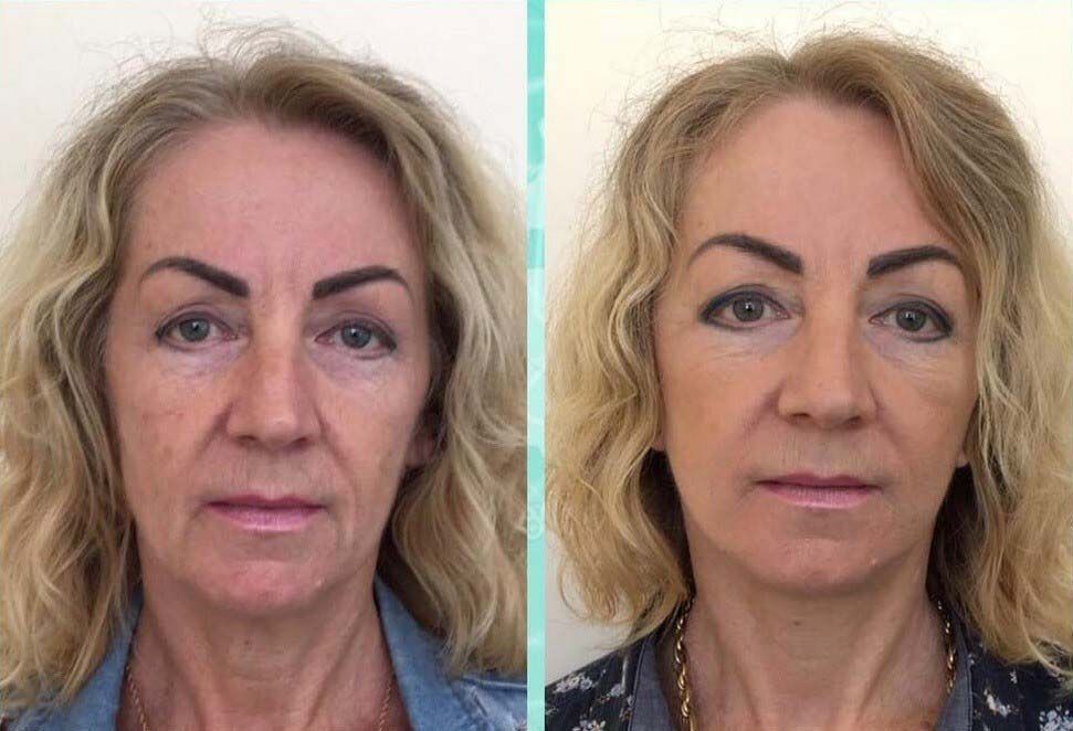 Пластика лица в 55 лет