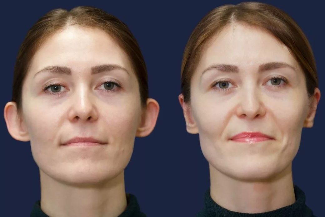 Отопластика