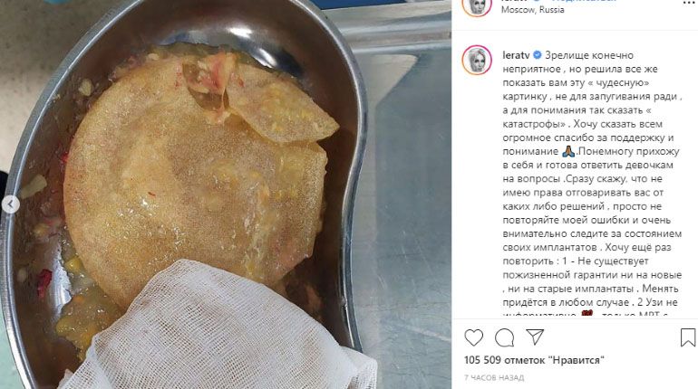 Разрыв имплантов