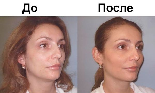 Эффект от процедуры