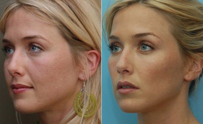 Эффект от процедуры 2