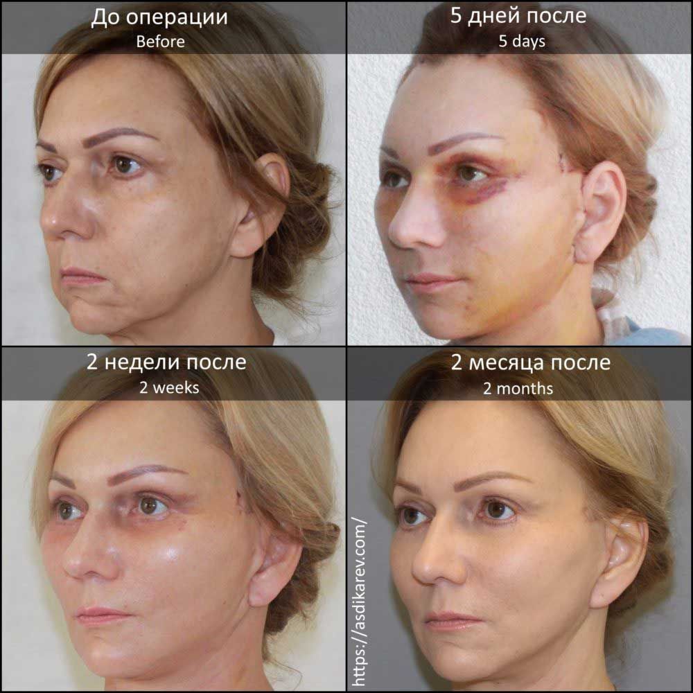 Процесс реабилитации после подтяжки