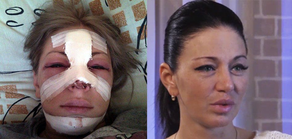 Саша Проджект пластическая операция