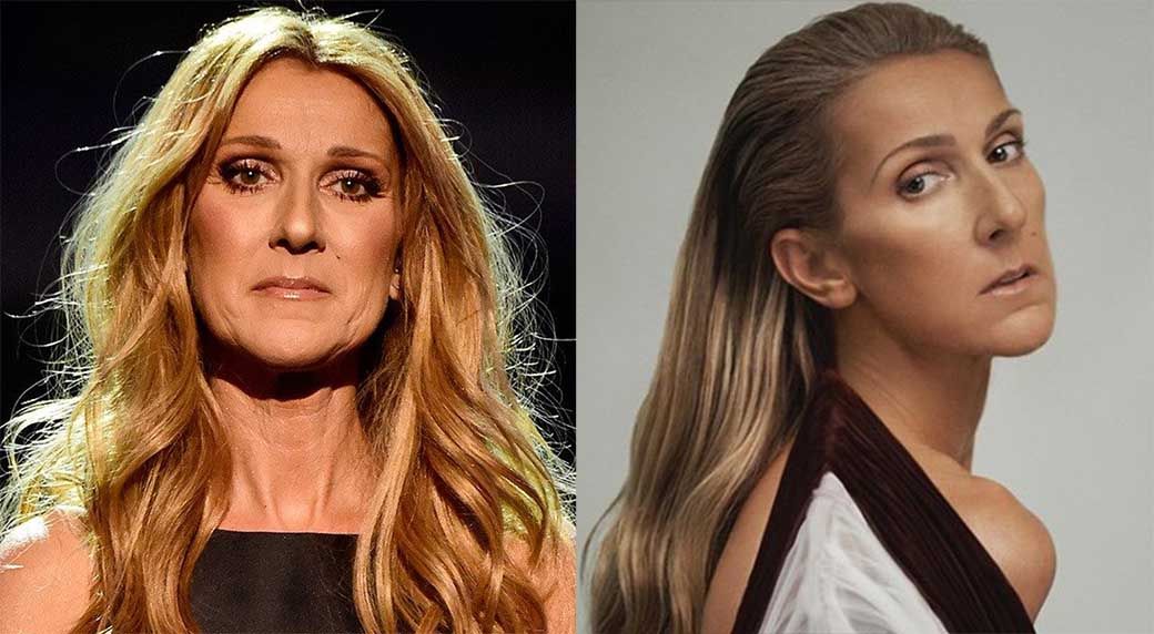 Селин Дион подтяжка лица