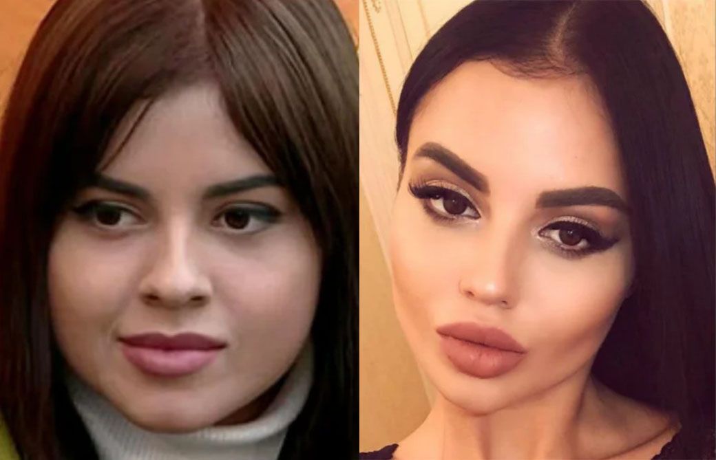 Шафеева ринопластика