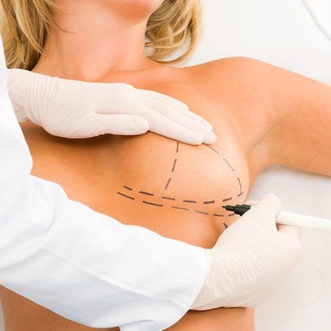 пластика на&nbsp;сосках