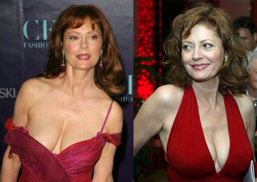 Сьюзан Сарандон маммопластика