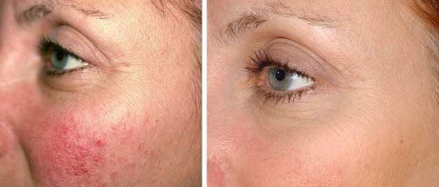 Недельное применение Троксевазина при куперозе