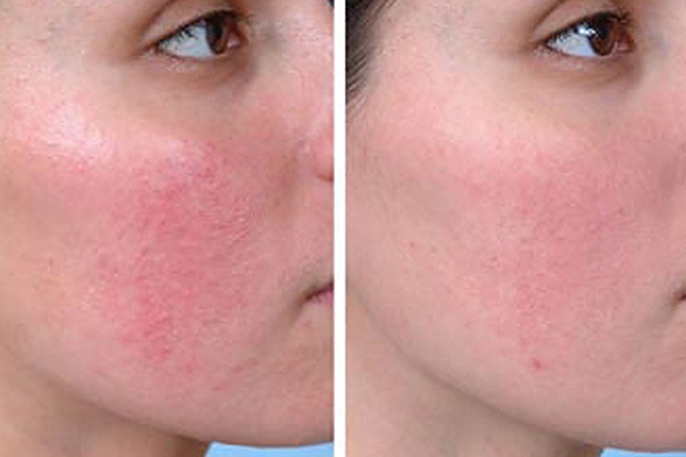 Действие Троксевазина на&nbsp;подростковой коже (4 дня применения)