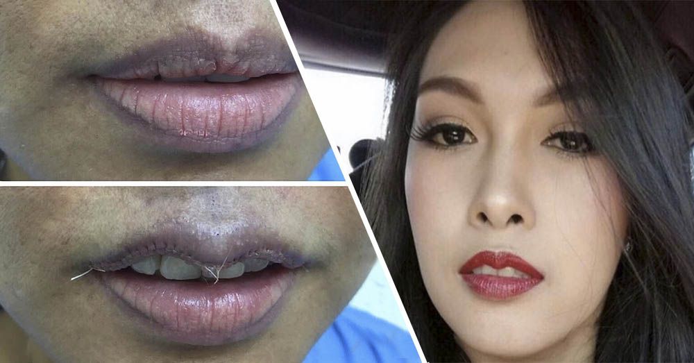 Ушивание губ